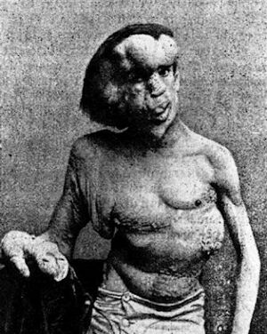 Joseph Merrick.jpg